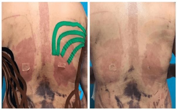 Kinesiology Tape After Surgery Kinesiology tape applied to support the body after surgery
