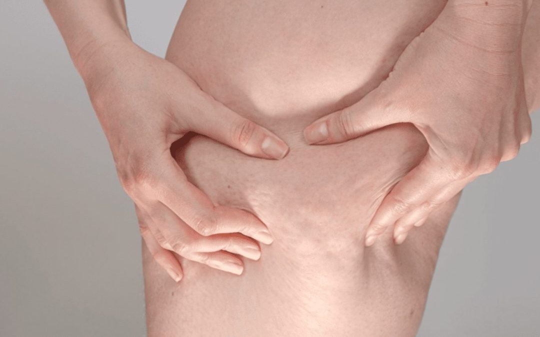 Can Body Wraps Help You Lose Weight?