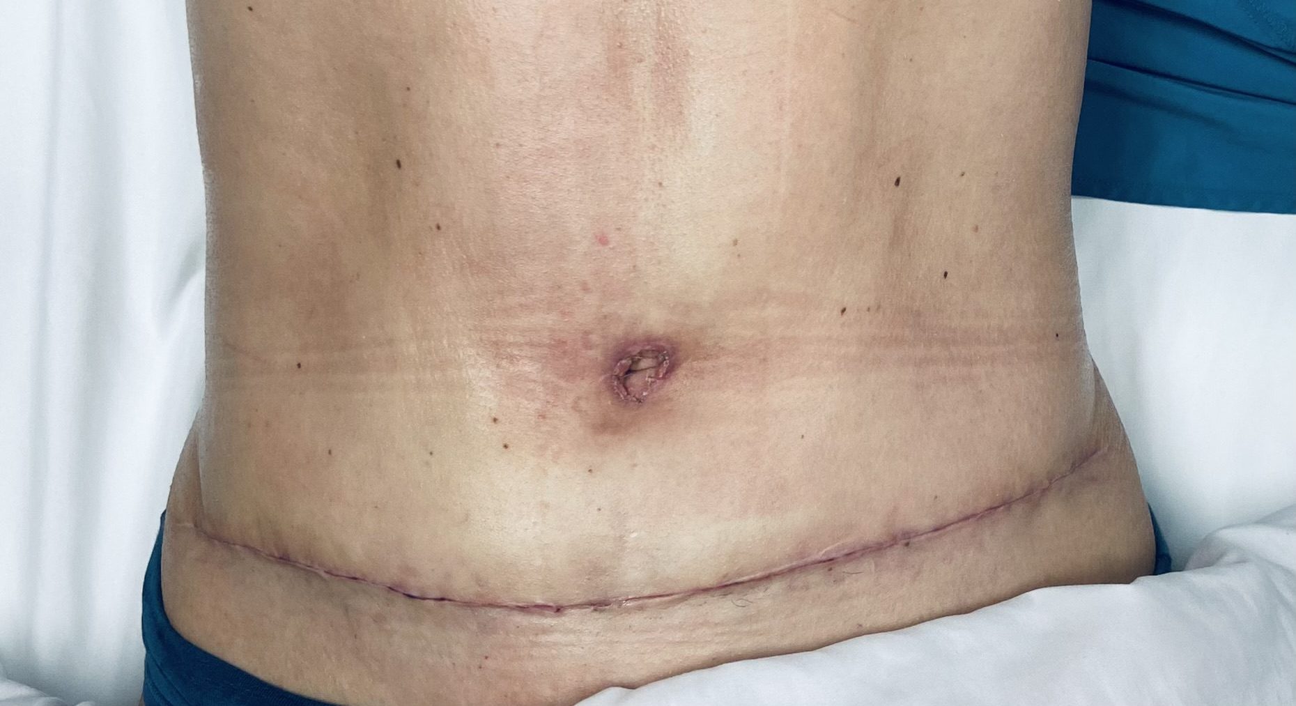 Client receiving lymphatic massage after cosmetic surgery in Houston